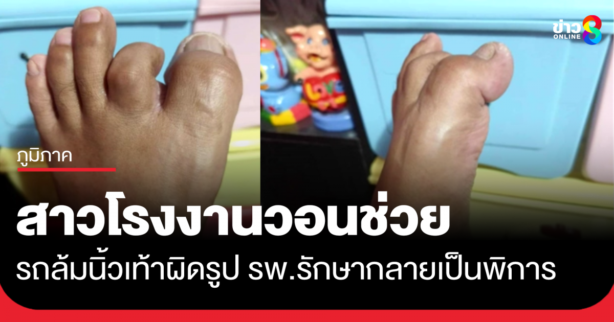 สาวโรงงานวอนช่วย-รถล้มนิ้วเท้าผิดรูป-รพ.รักษา-กลายเป็นนิ้วเท้าพิการ-–-ช่อง-8