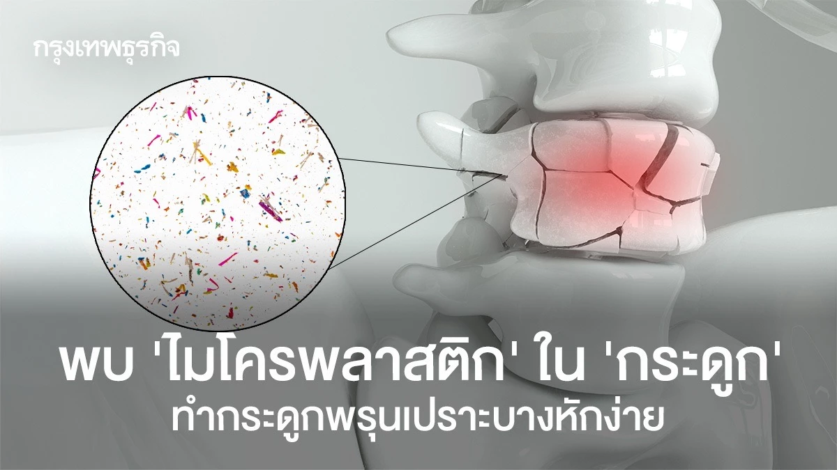 พบ-‘ไมโครพลาสติก’-ใน-‘กระดูก’-ทำกระดูกพรุนเปราะบางหักง่าย
