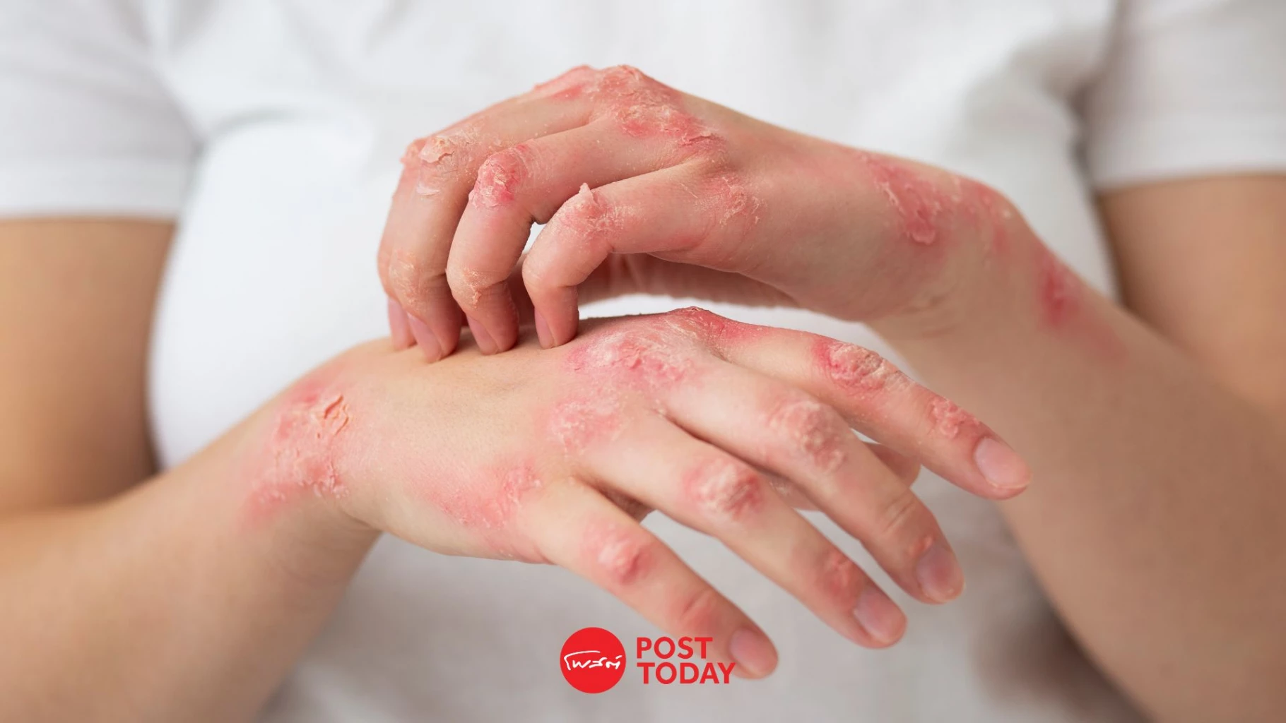 รัฐบาลเผยยอดป่วย-“ฝีดาษวานร”-สะสม-1,000-ราย-กทม.ครองแชมป์