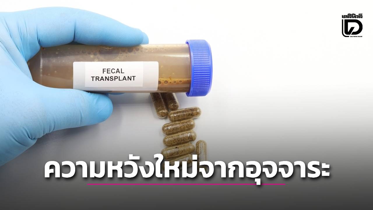 ผลวิจัยชี้-“ยาเม็ดอุจจาระ”-คือจุดเปลี่ยนกระบวนการรักษาโรคมะเร็ง-|-เดลินิวส์